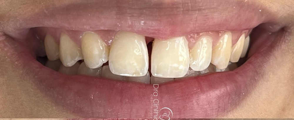Sorriso antes do tratamento odontológico