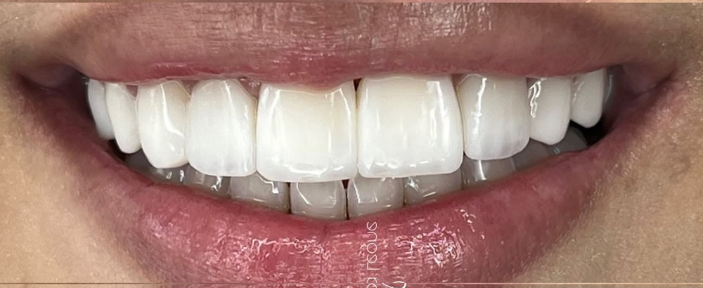Resultado depois do tratamento odontológico