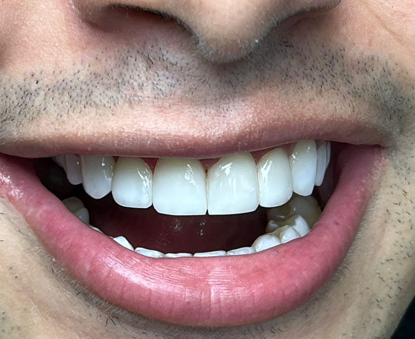 Resultado de facetas em resina