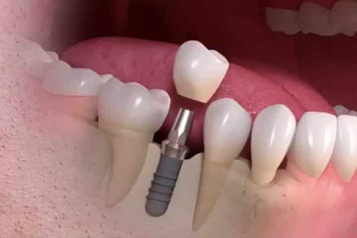 Tratamento com implante dentário